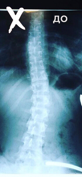 лечение сколиоза Минск